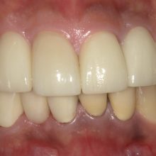 全体的にボロボロなのでインプラントをやりたい