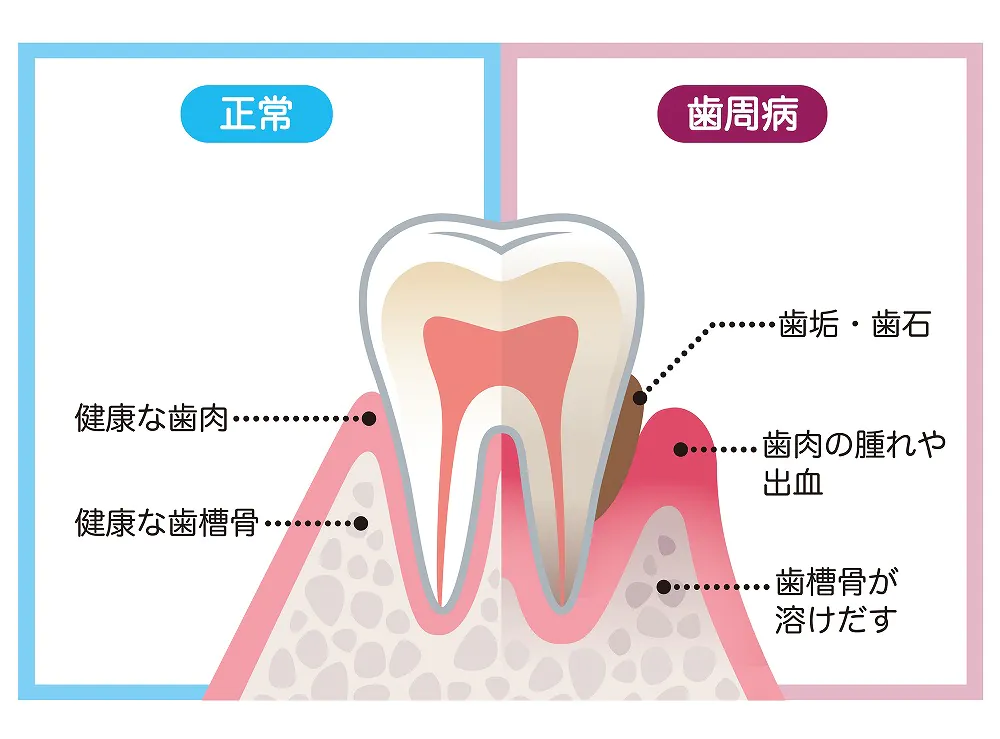 歯周病は成人が歯を失う原因No.1
