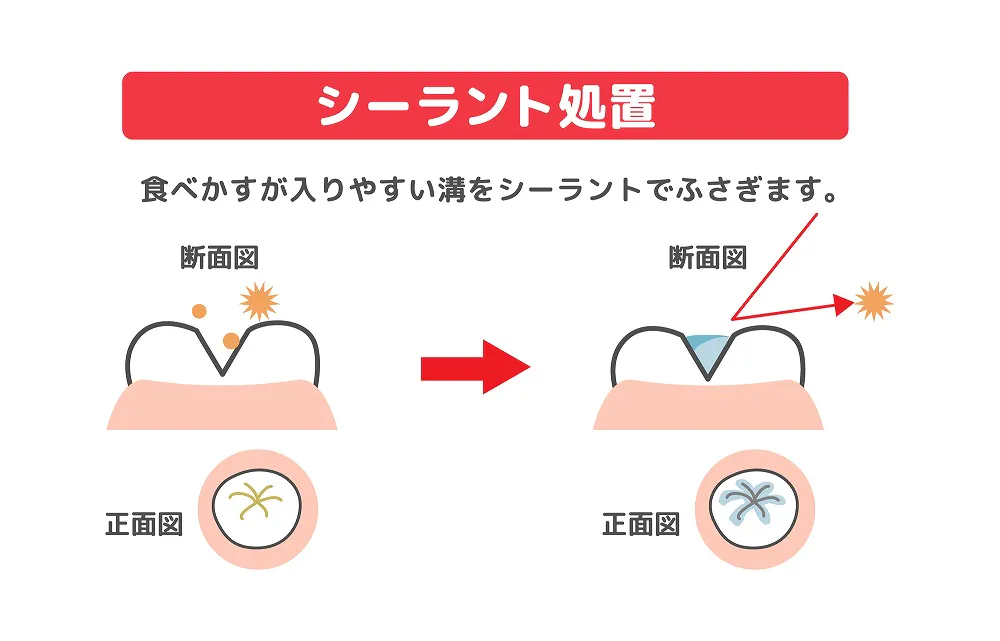 シーラント処置