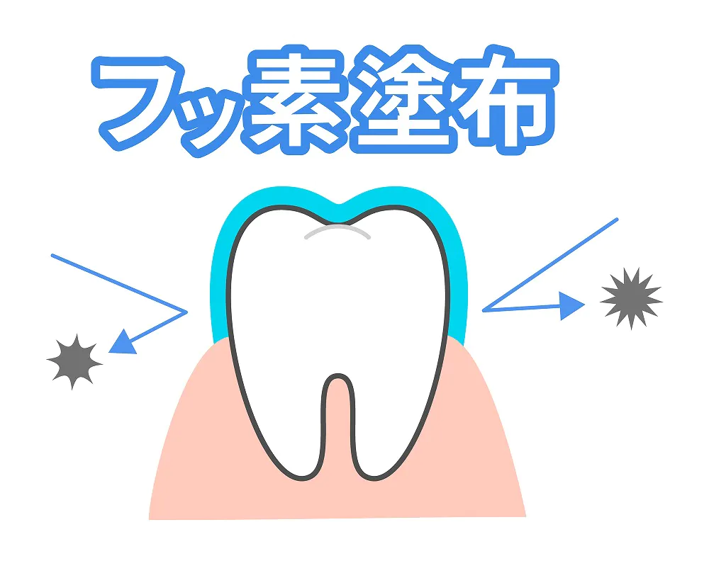 フッ素の塗布